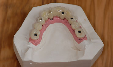 denti provvisori in leghe palladiate fuse e cementate