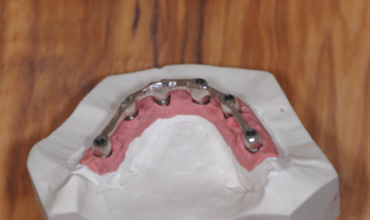 denti provvisori in leghe palladiate fuse e cementate